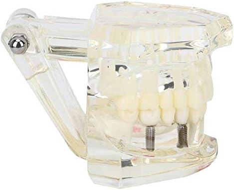 Волфрон Транспарентно стоматолошко заболување Модел модел на лабораториска патолошка студија Настава за заби модел 3.7x3.0x2.6in,