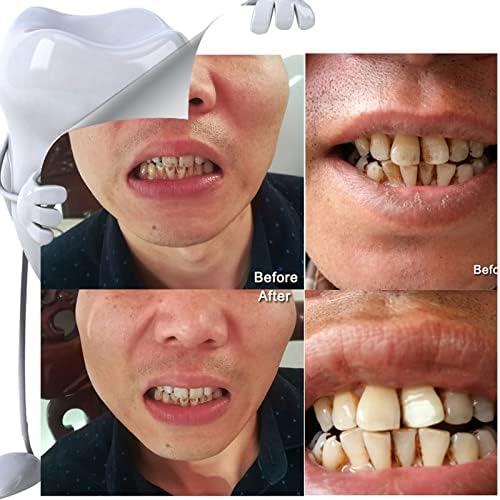 Белење на забите, отстранувач на плаки Отстранување на тврдоглави дамки од заби и забен камен чисто природно физичко чистење избришете