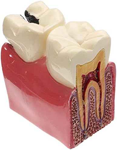 Компаративниот модел на заби за распаѓање KH66ZKY - 6 пати модел на забни кариес - алатки за настава за заби за настава и студија