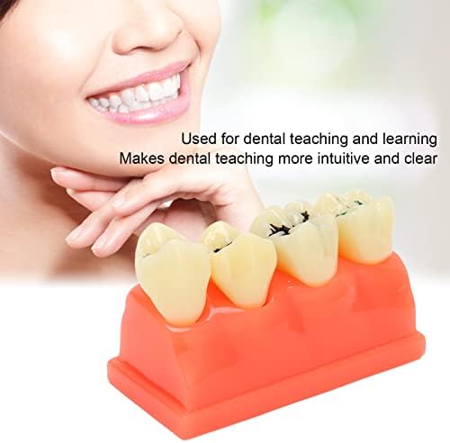 Скршен модел на заби со резбаниран кариес модел на стоматолошка практика за наставни модели за демонстративни цели