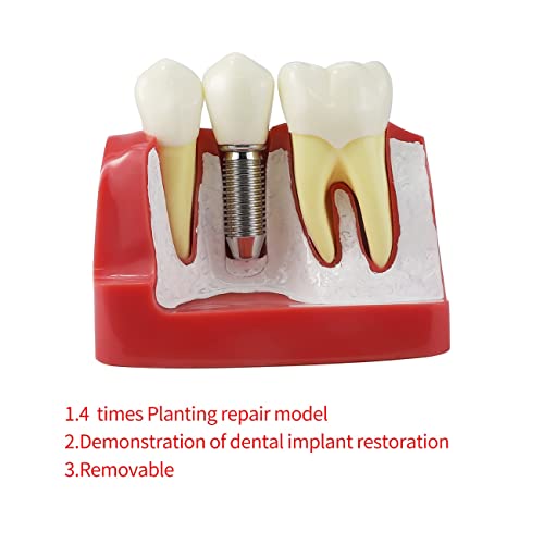 Teptoarch 4 пати Дентатолошки наставни анализи на имплантација, крунски мост, отстранлив модел за заби за заби модел на заби